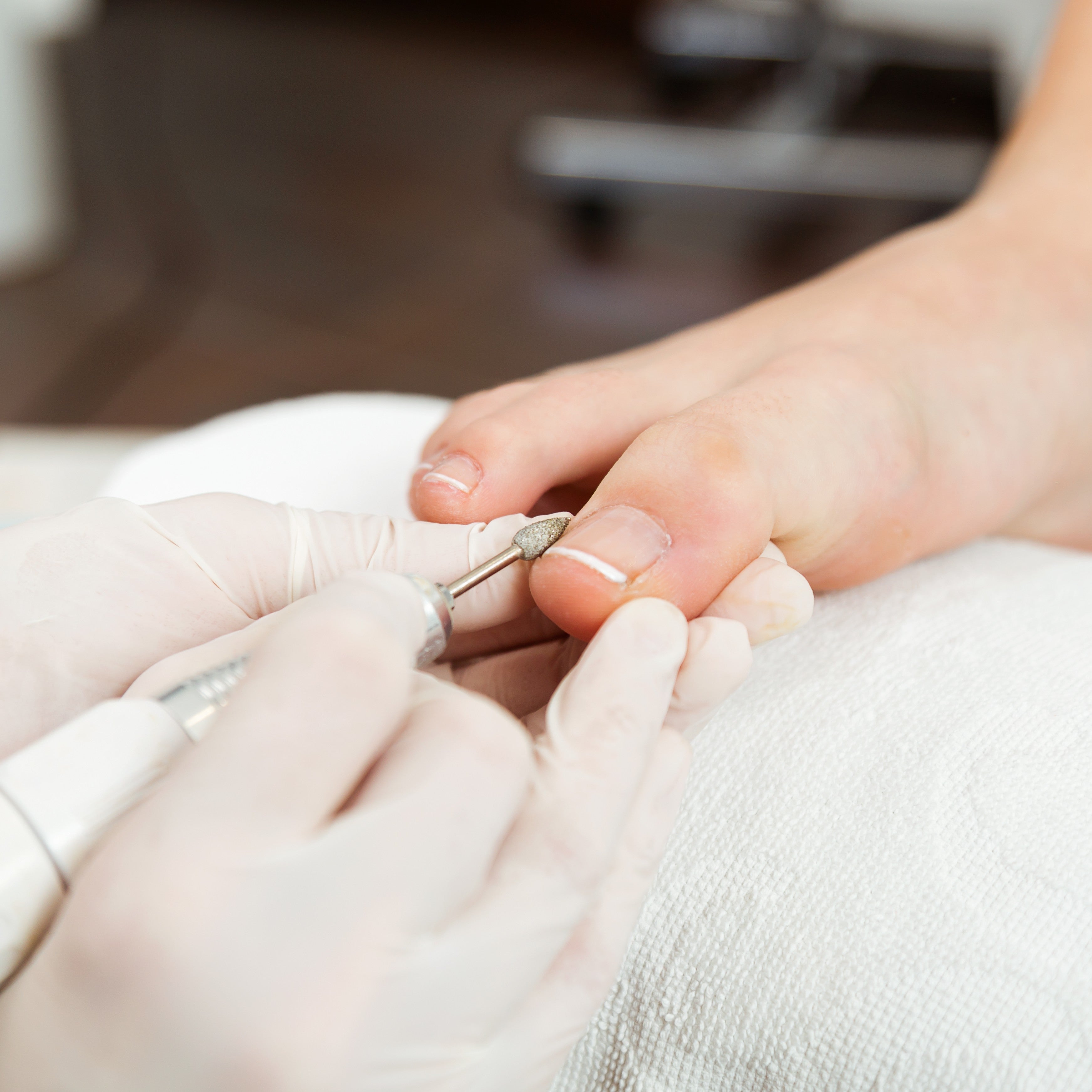 Keratosis Treatment | Pedicure